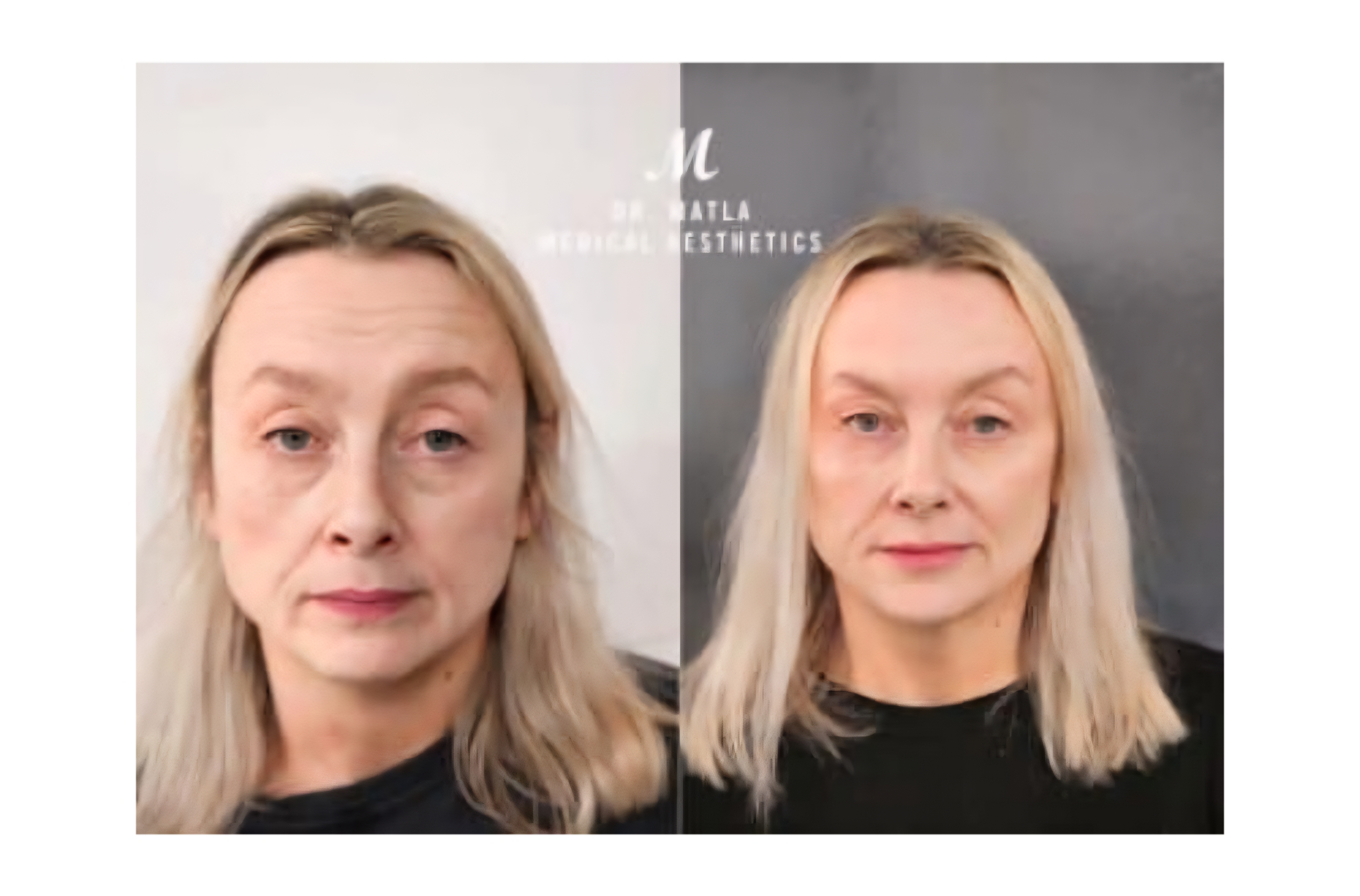 Eye thread lift
